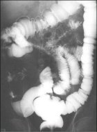Crohnova choroba RTG